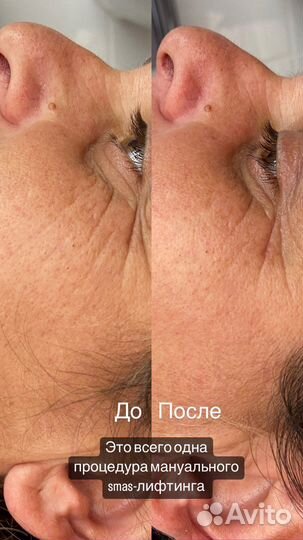 Чистка лица массаж отбеливание
