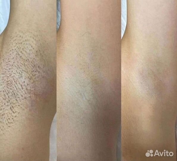 Лазерная эпиляция/элос эпиляция