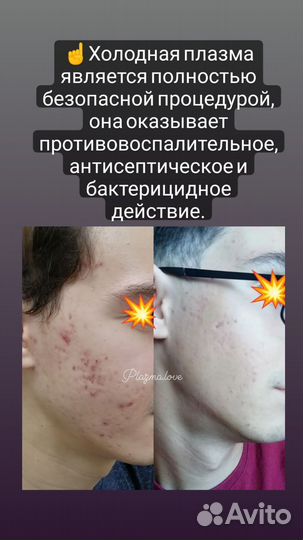 Удаление папиллом