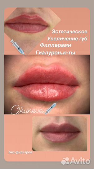 Модель на Увеличение губ. Ботокс. Пиллинг. Истра