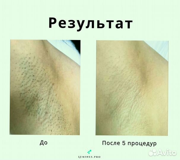 Аппарат для эпиляции Lumines’ Max’One 1200вт