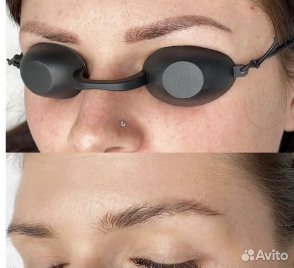 Лазерное удаление татуажа и тату, и ремувером