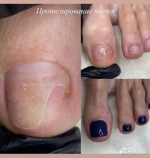 Подолог. Вросший ноготь. Мозоли. Грибок. Ортез