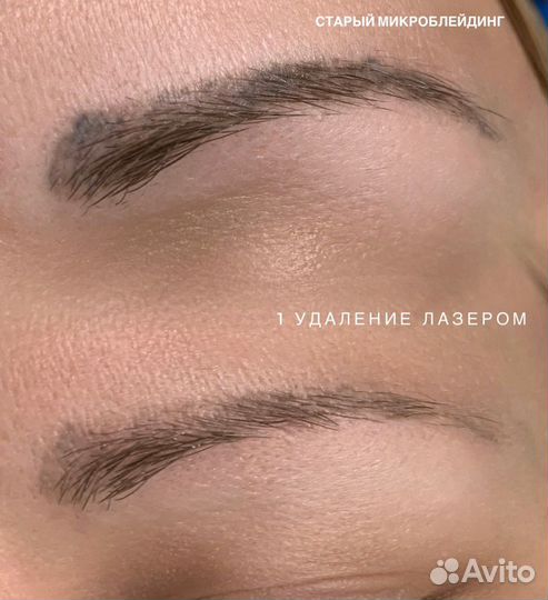 Удаление татуажа Брови/губы/стрелки Лучший Лазер