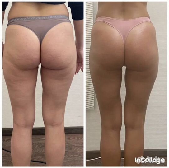 Vela shape/коррекция фигуры/rfлифтинг/кавитация