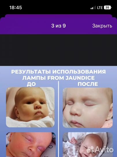 Аренда лампы от желтушки