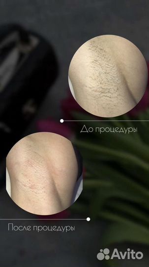 Депиляция/шугаринг Тула