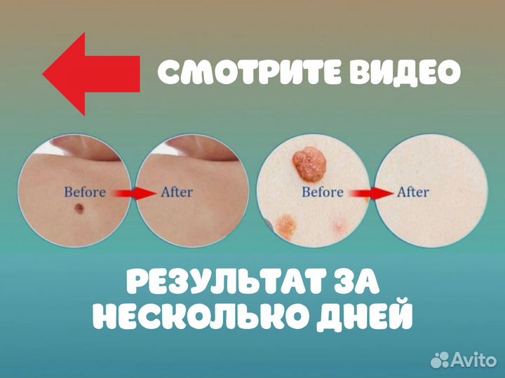 Удаление папиллом и бородавок самостоятельно