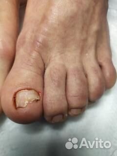 Педикюр подолог