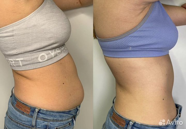 Жиротоп. Липолитики для тела у топ-косметолога