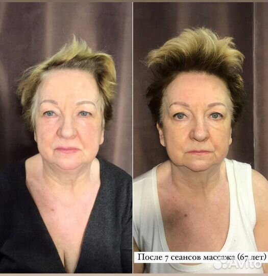 Массаж лица и головы миофасциальный