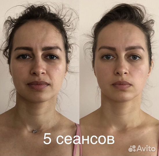 Фейспластика