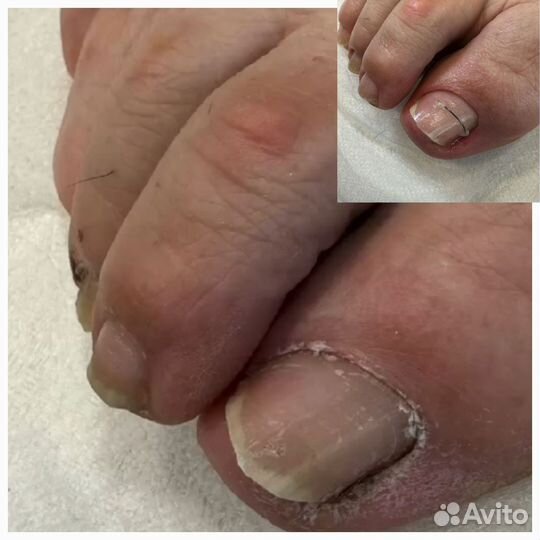 Подолог(проблемные ногти,стопы)