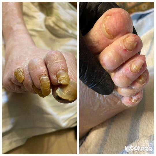 Медицинский педикюр. Подолог