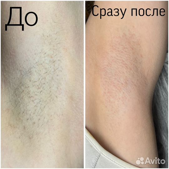 Электроэпиляция