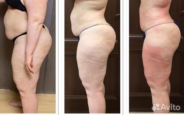 LPG-массаж тела и лица