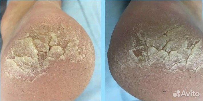 Медицинский педикюр вросший ноготь