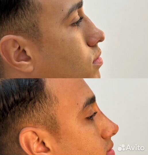 Контурная пластика моделирование лица