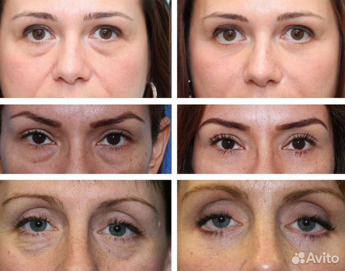 Аппаратное похудение и омоложение Индиба