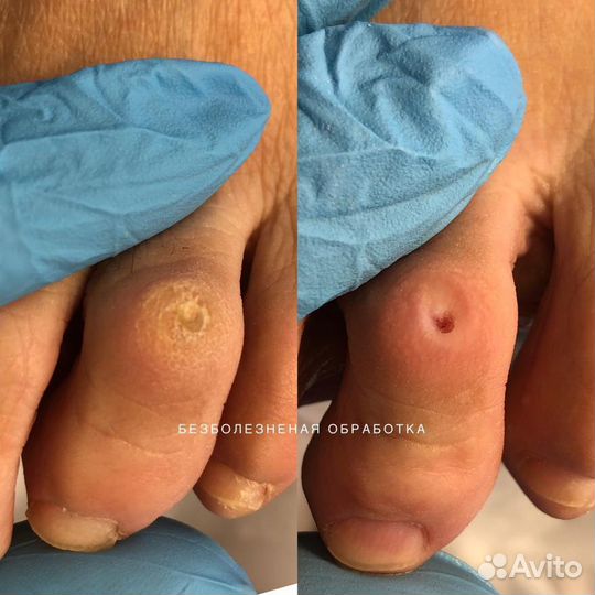 Подолог.Медицинский педикюр.Титановая нить