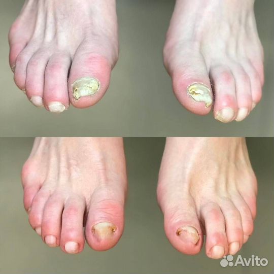 Подолог. Лечебный педикюр. Без боли