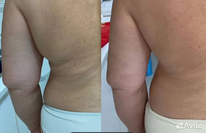 Плоский живот - размер за 1 процедуру