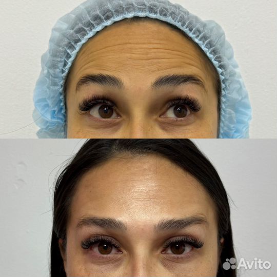 Ботулинотерапия