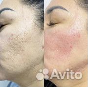 Microneedling RF