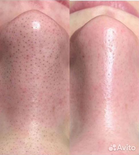 Косметолог чистка лица