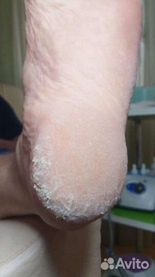 Педикюр на дому