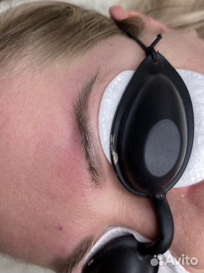 Удаление татуажа лазером, удаление тату