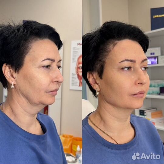 Косметолог: Губы, липолитики, мезотерапия, ботокс