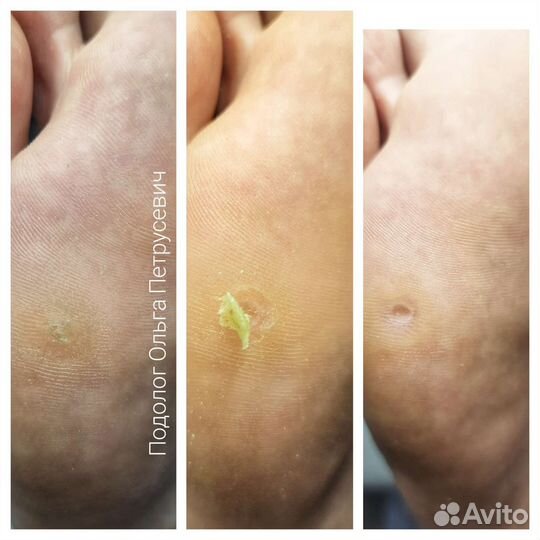 Подолог-вросший ноготь,стержневая мозоль