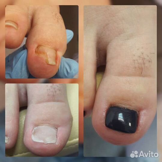 Педикюр. Подология