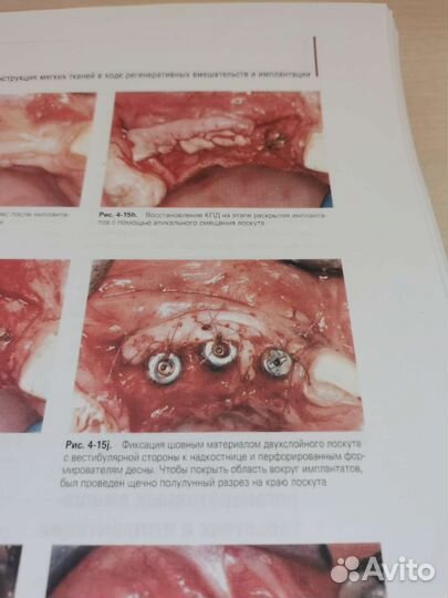 Регенеративные методы в имплантологии