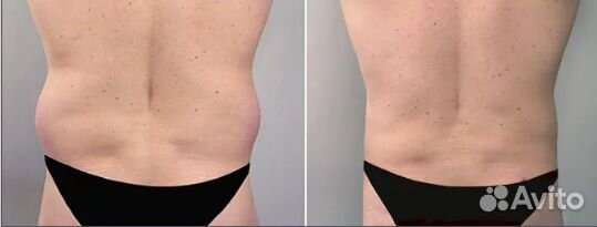 Липосакция, жиротоп и похудение Липосоникс