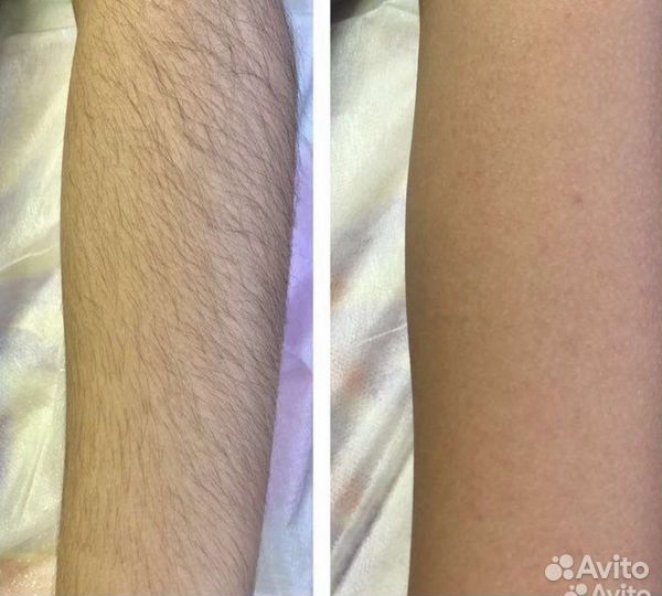 Шугаринг на дому сахарной пастой