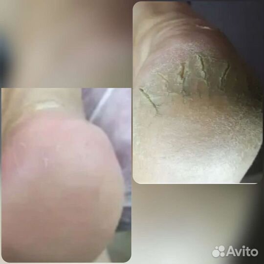 Педикюр мужской