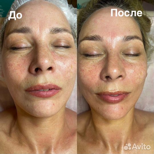 Омолаживающий массаж лица