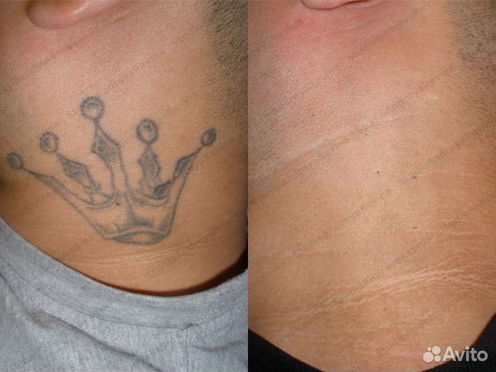 Удаление тату