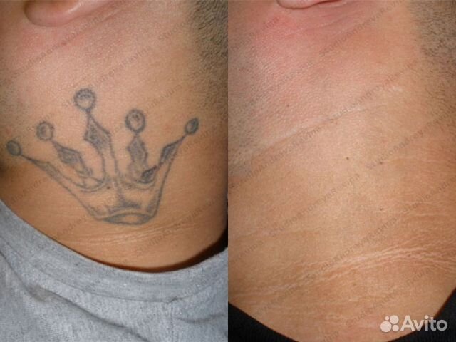 Удаление тату