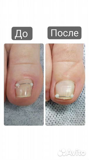 Коррекция вросших ногтей