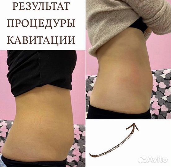 Ультразвуковая кавитация