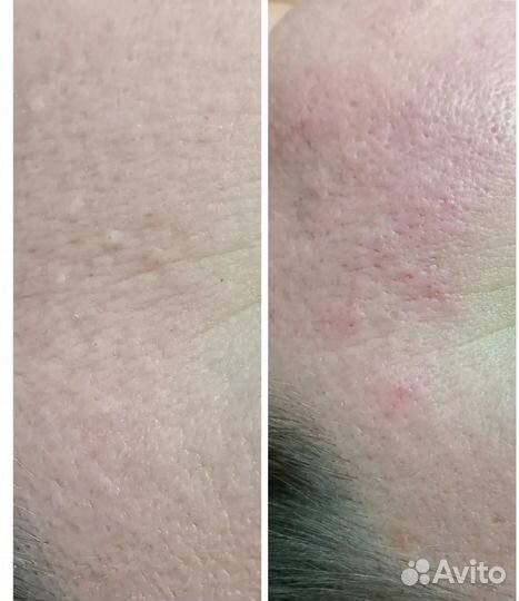 Косметолог чистка лица,пилинг