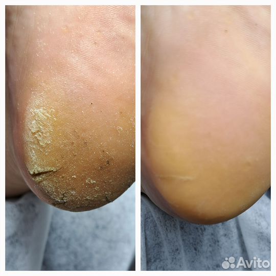 Педикюр проблемных стоп и ногтей (Подолог)