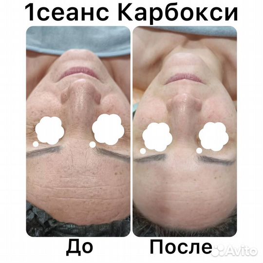 Ищу модель карбокситерапия