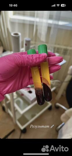 Плазмолифтинг