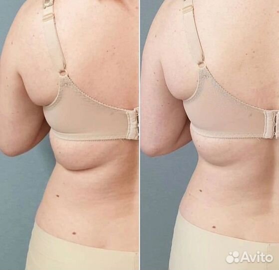 Похудение Турбо-Жиротоп Липосоник