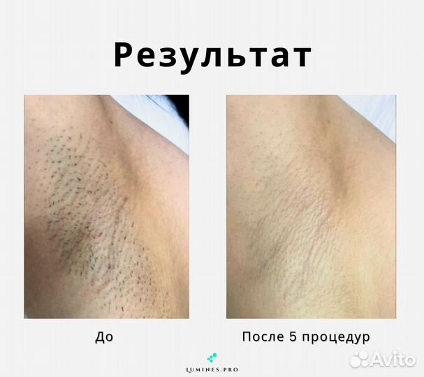 Аппарат для эпиляции «Lumines» Max’One 1200в