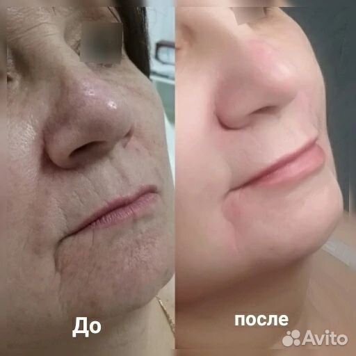 Холодная плазма, Импульсная спрей-коагуляция кожи